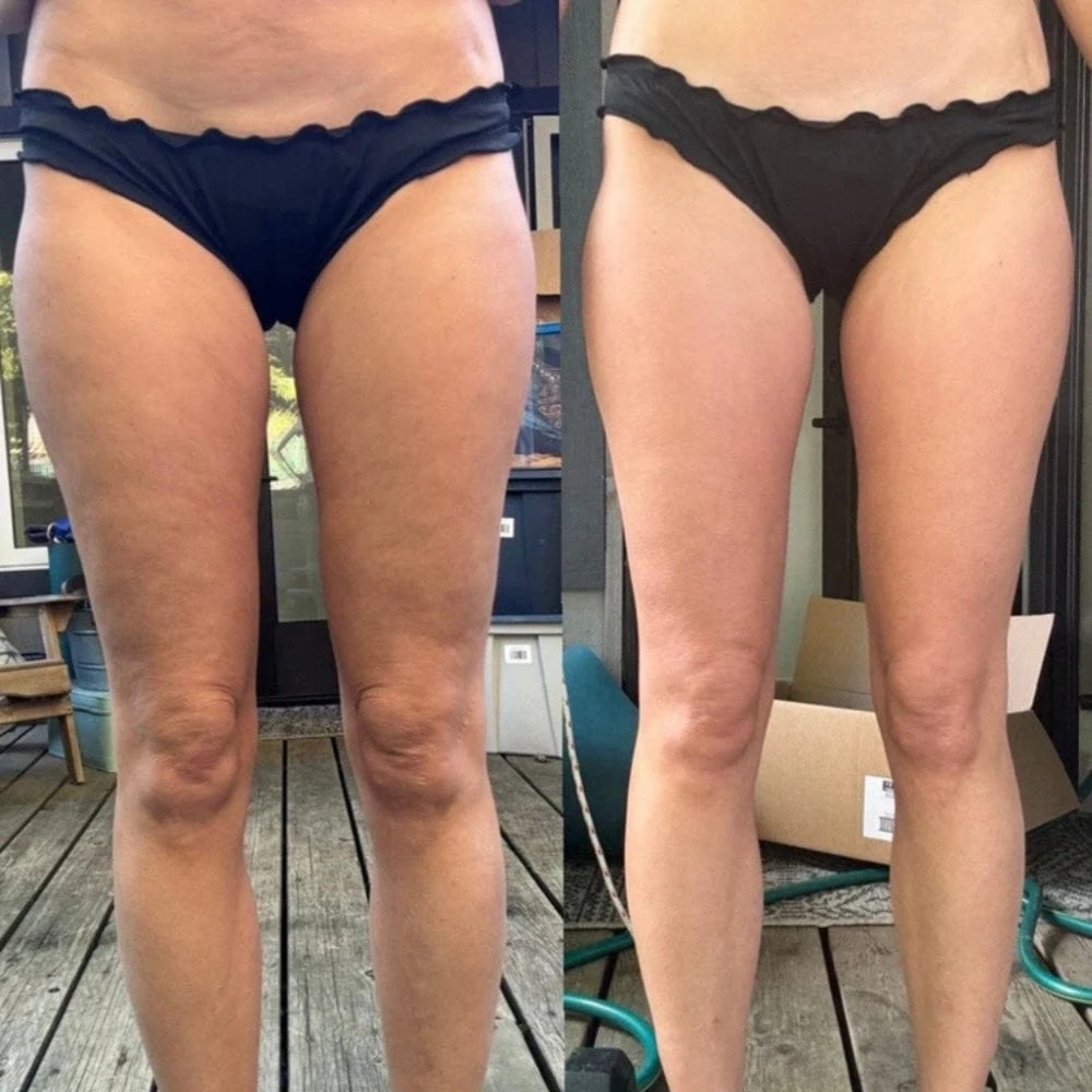 Kiyame™ - Anti-Cellulite Massager